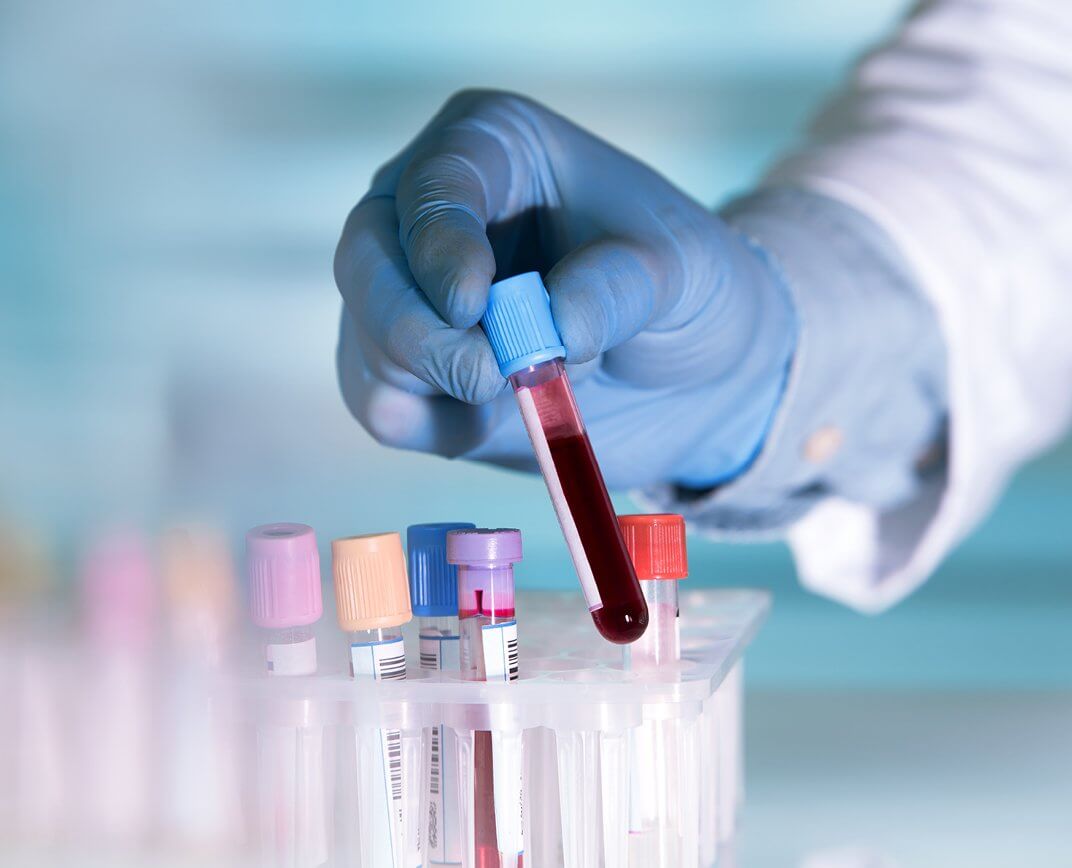 Laboratórne testy krvi